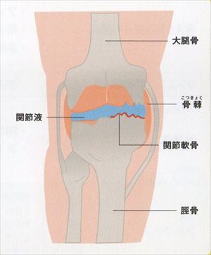 変形性膝関節症_R.jpg