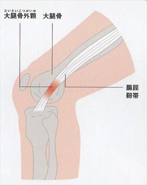 腸脛靭帯炎（ランナー膝）_R.jpg
